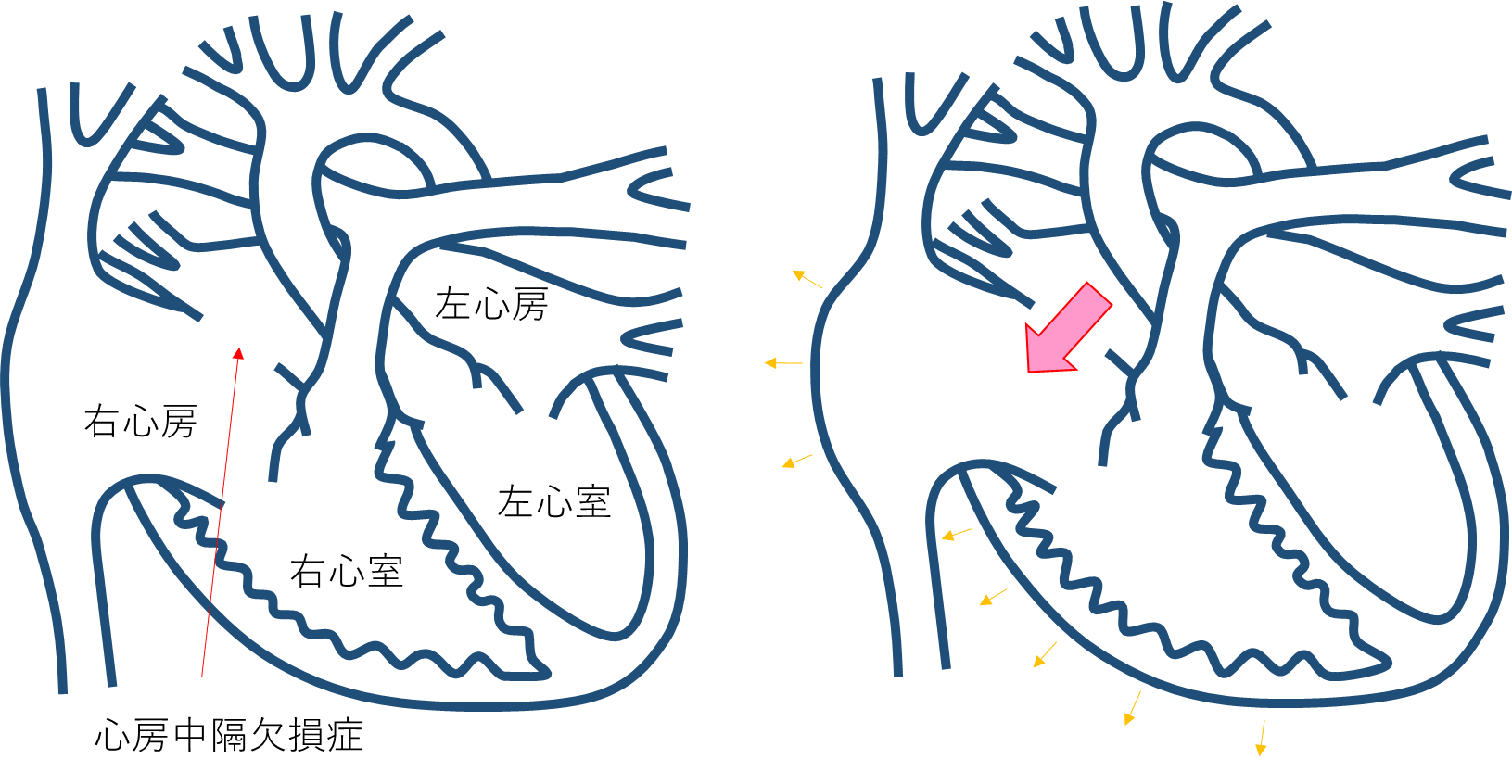 心房中隔欠損症（ASD）とは