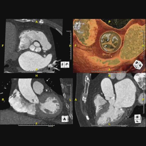 大動脈弁植込み術1