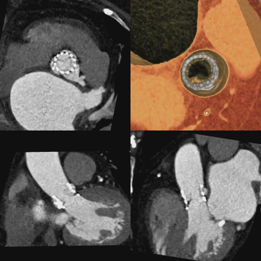大動脈弁植込み術2
