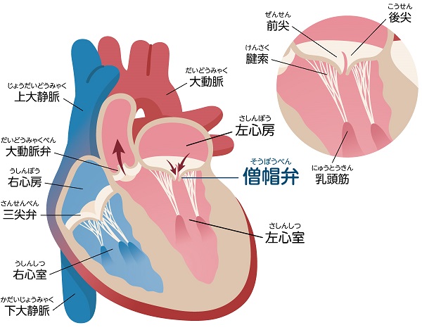 僧帽弁閉鎖不全症とは