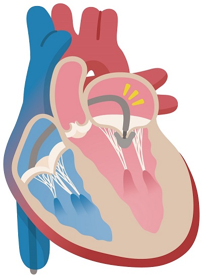 経皮的僧帽弁接合不全修復術