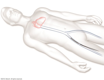 心臓までアプローチ01