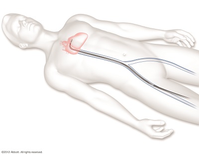 心臓までアプローチ02