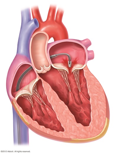 心臓までアプローチ03