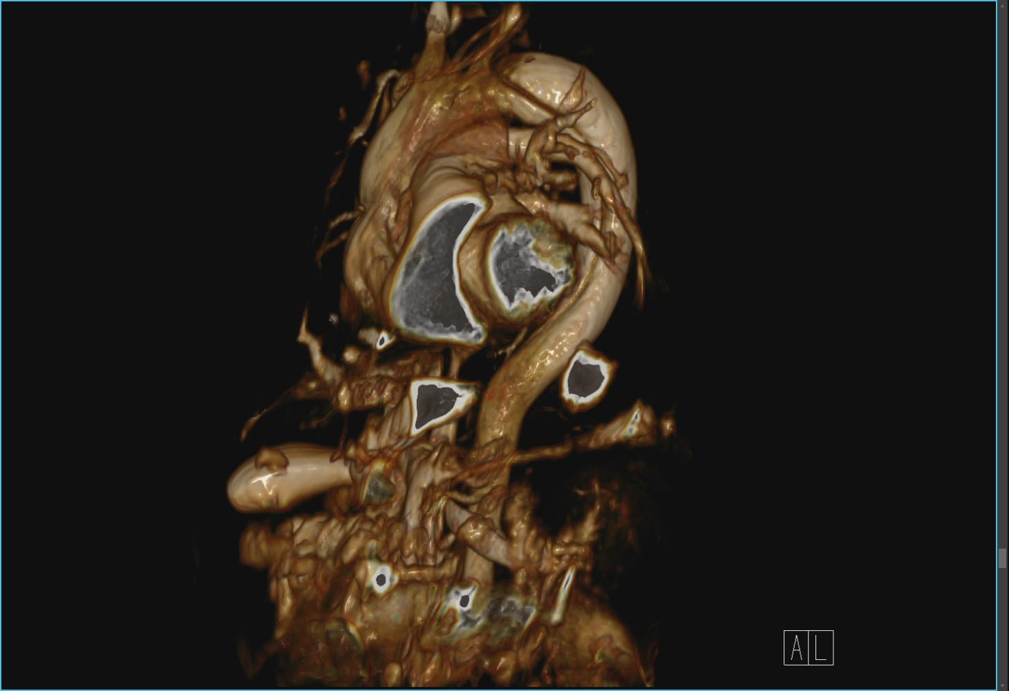 慢性大動脈解離のMRI1