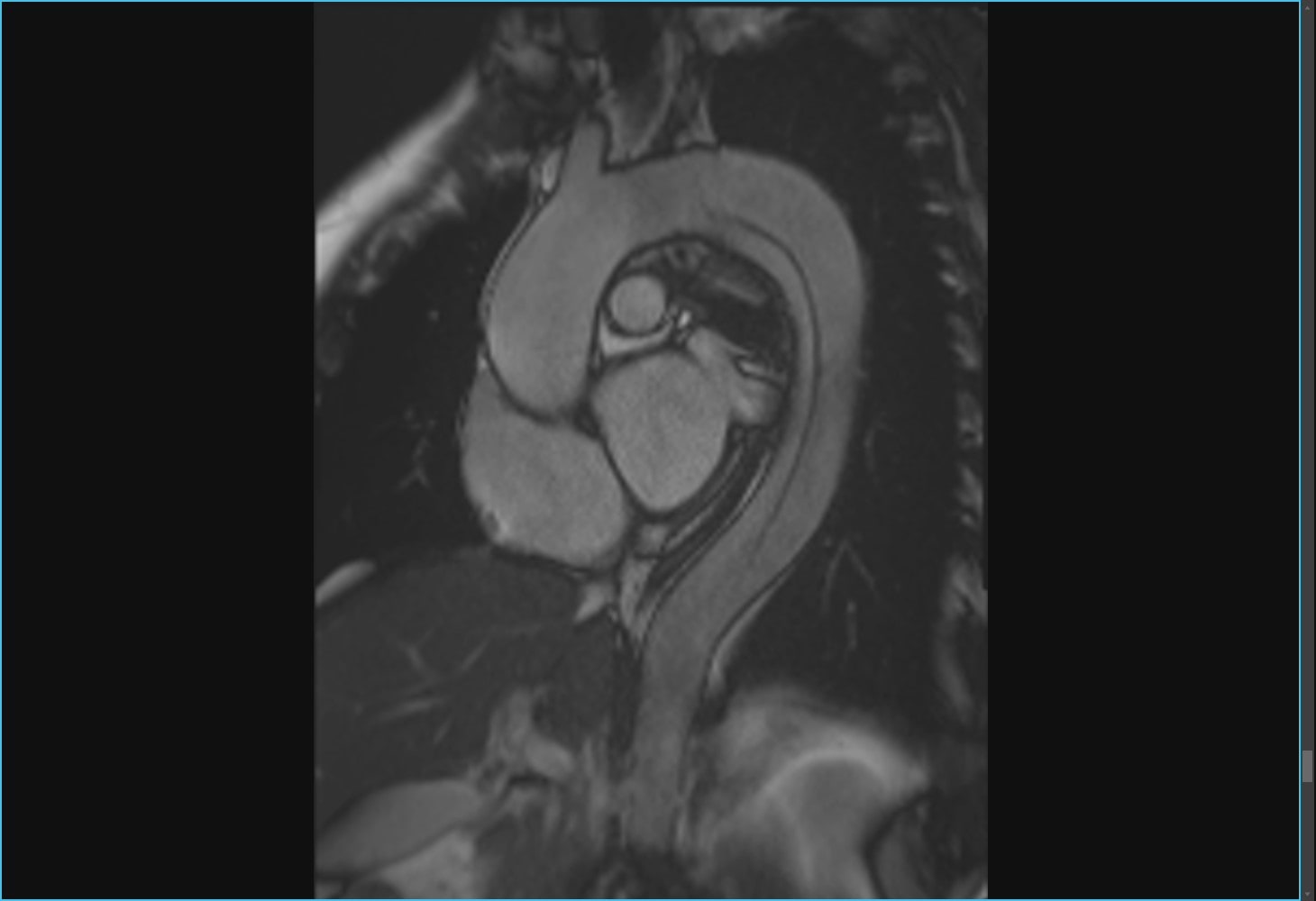 慢性大動脈解離のMRI2