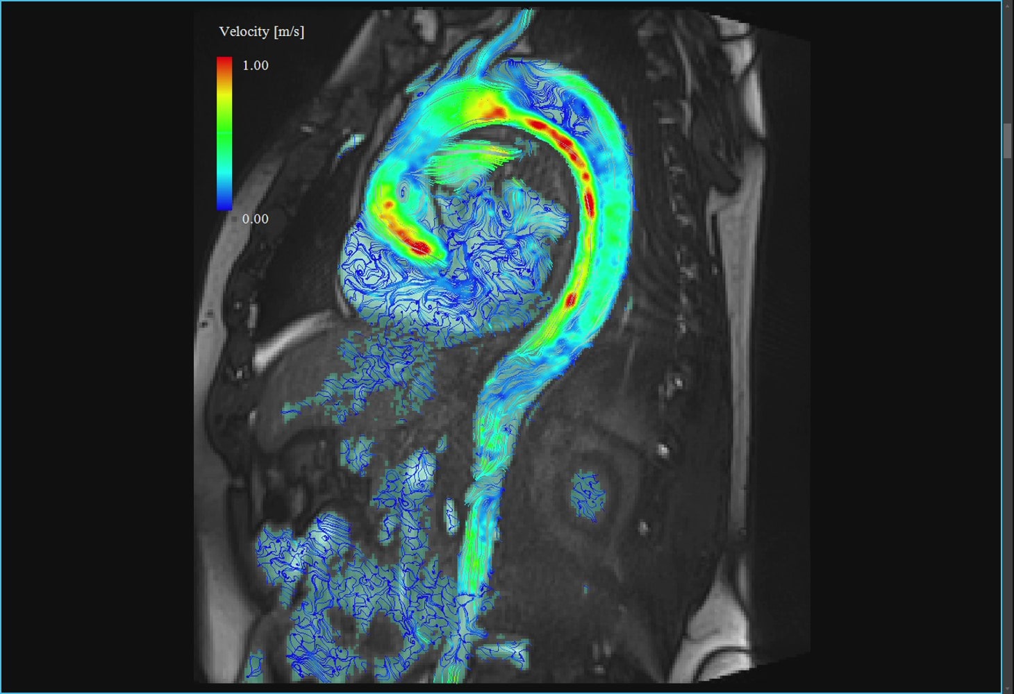 慢性大動脈解離のMRI3