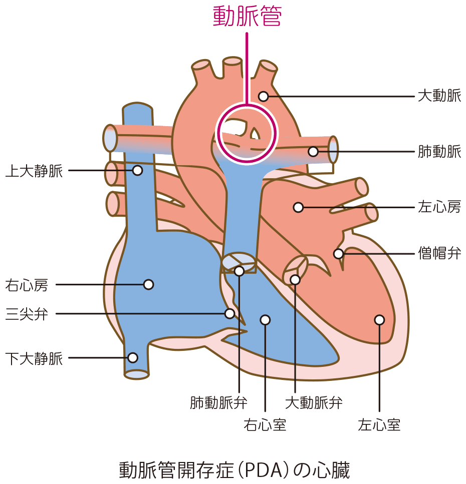 動脈管開存症（PDA）とは