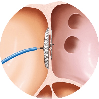 カテーテルによる治療