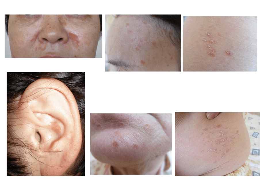 サルコイドーシスの皮膚症状