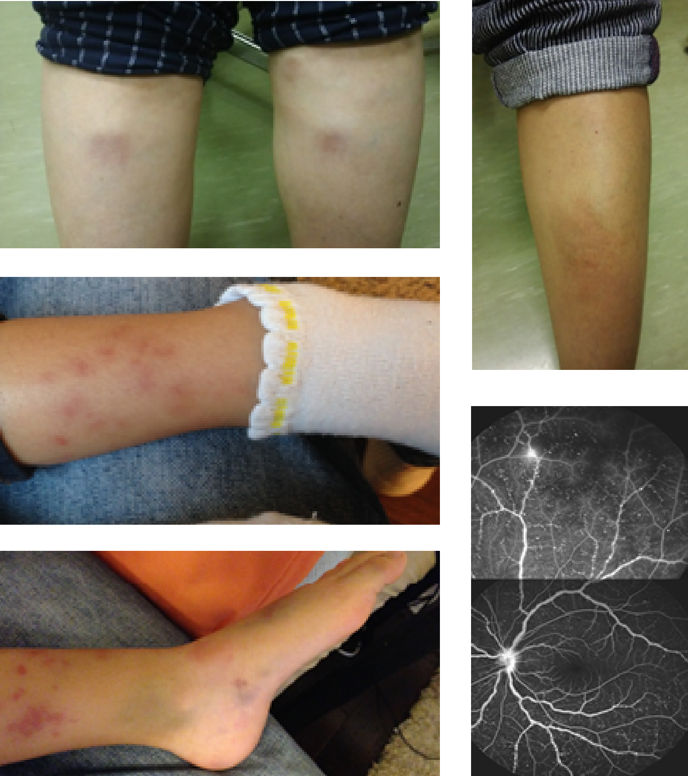 高安病は全身の血管に炎症を起こす