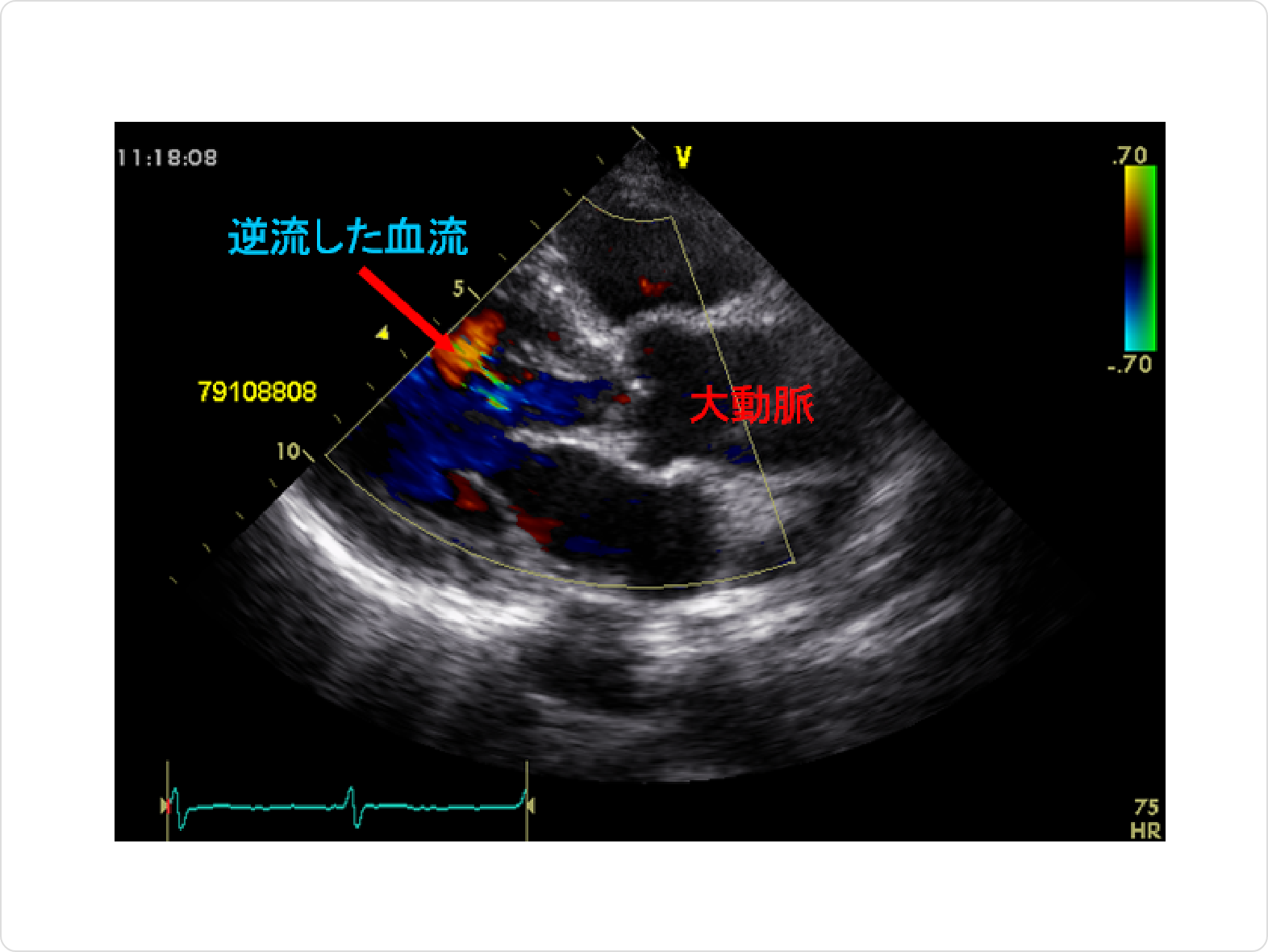心臓超音波（心エコー）