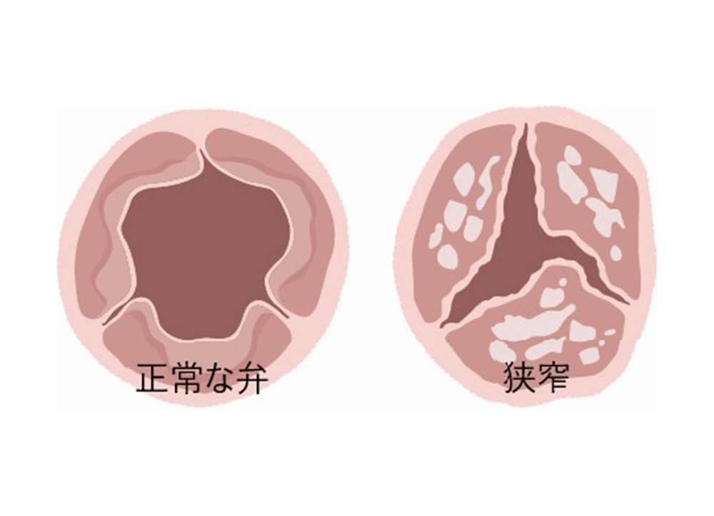 大動脈弁狭窄症