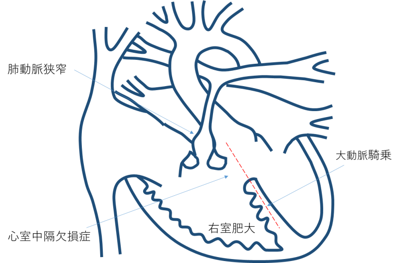 ファロー四徴症とは