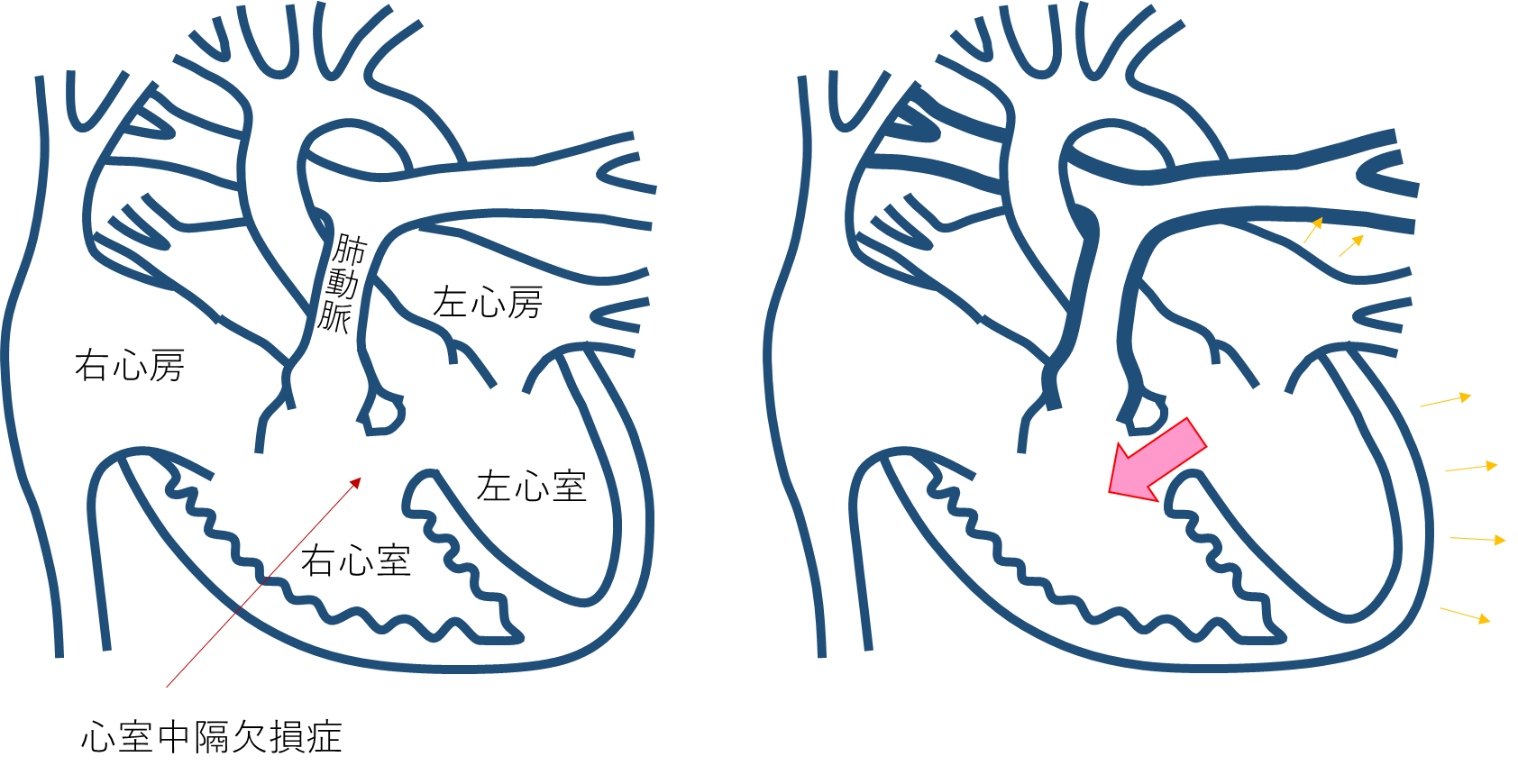 心室中隔欠損症（VSD）とは