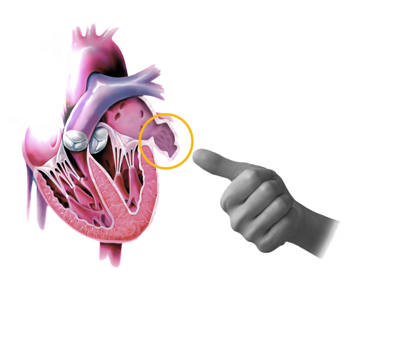 心房細動と心原性脳梗塞