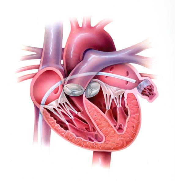 左心耳閉鎖治療03
