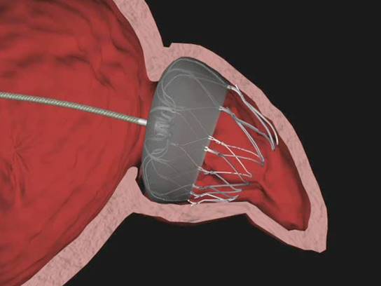左心耳閉鎖治療04