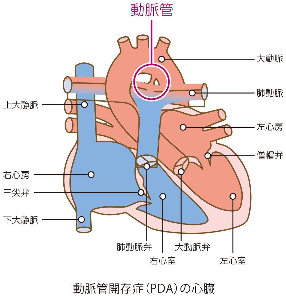 動脈管開存症のカテーテル治療 榊原記念病院 東京都府中市